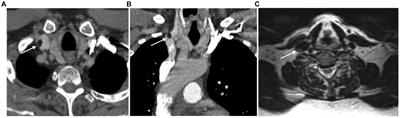 Intravenous lipomas of head and neck: an exceptional entity and its clinical implications